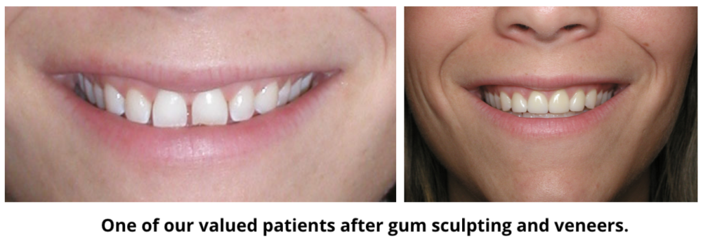 One of our valued patients after gum sculpting and veneers.
