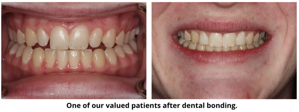 One of our valued patients after cosmetic dentistry dental bonding service at South Shore Dentistry in South Weymouth, MA.