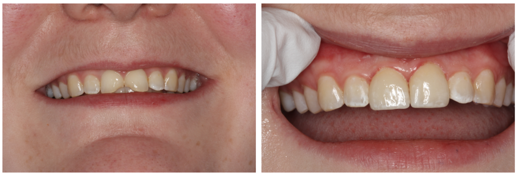 Before and after from restorative dentistry services at South Shore Dentistry in South Weymouth, MA. 