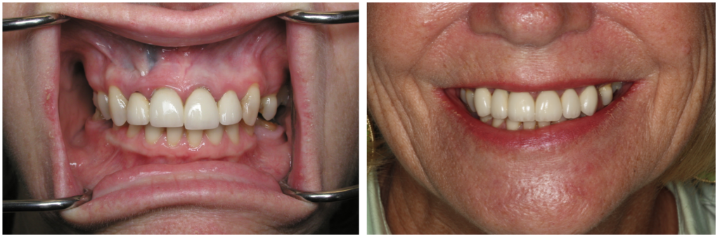 Before and after from restorative dentistry services at South Shore Dentistry in South Weymouth, MA. 