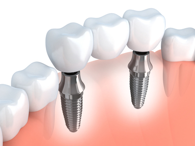 diagram showing how dental implants can be placed