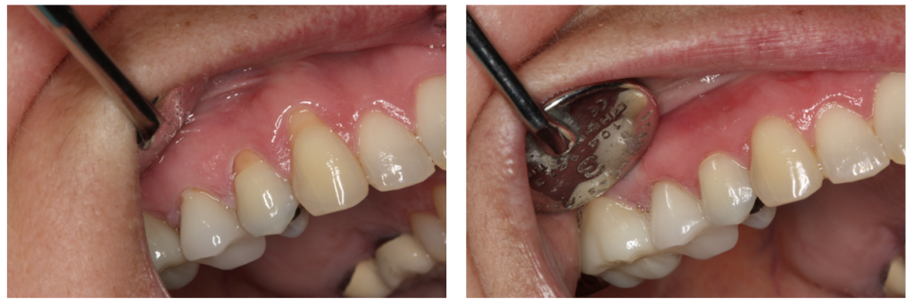 Before and after shot after gum disease treatment.