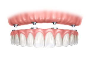 all-on-4 dental implants image